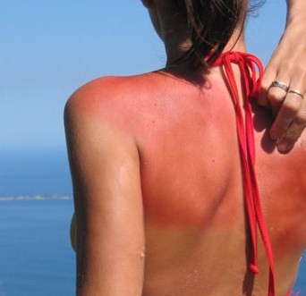 Come curare bruciatura da medusa