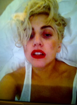 lady gaga contusa dopo l'incidente sul palco lady gaga twitter